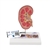 3B Scientific Kidney Stone Model - 3B Smart Anatomy