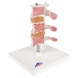 3B Scientific Deluxe Human Osteoporosis Model (3 Vertebrae with Discs ), Removable on Stand Smart Anatomy