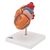 3B Scientific Classic Human Heart Model with Left Ventricular Hypertrophy (LVH), 2 Part Smart Anatomy