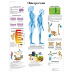 3B Scientific Osteoporosis Chart