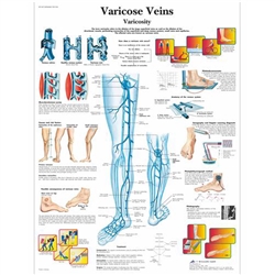 3B Scientific Varicose Veins Chart