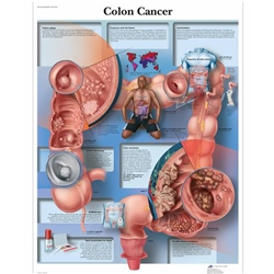 3B Scientific Colon Cancer Chart