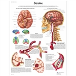 3B Scientific Stroke Chart