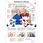 3B Scientific Alzheimer's Disease Chart