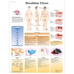 3B Scientific Decubitus Ulcers Chart