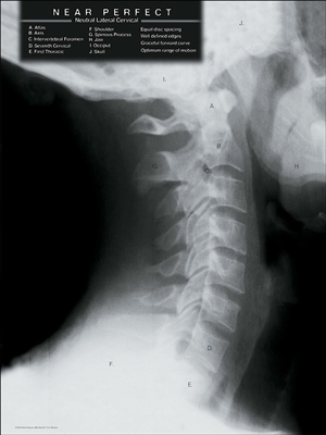 Spinal Decay X-ray Chart