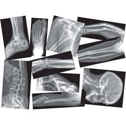 Broken Bones X-Rays By Roylco