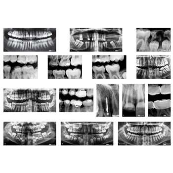 Dental Xrays, R-59269