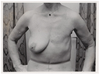 Mastectomy