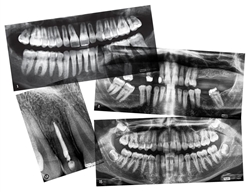 Dental-X-Rays