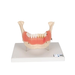 3B Scientific Dental Disease Model, Magnified 2 Times, 21 Parts - 3B Smart Anatomy