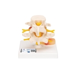 3B Scientific Human Lumbar Spinal Column with Prolapsed Intervertebral Disc - 3B Smart Anatomy