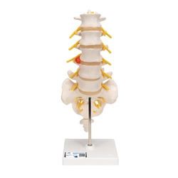 3B Scientific Human Lumbar Spinal Column Model with Dorso - Lateral Prolapsed Intervertebral Disc - 3B Smart Anatomy