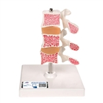 3B Scientific Deluxe Human Osteoporosis Model (3 Vertebrae with Discs), Removable on Stand - 3B Smart Anatomy