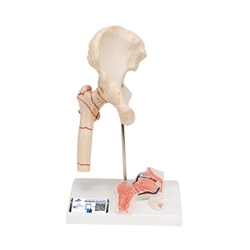 3B Scientific Human Femoral Fracture & Hip Osteoarthritis Model - 3B Smart Anatomy