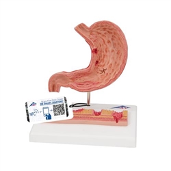 3B Scientific Human Stomach Section Model with Ulcers - 3B Smart Anatomy