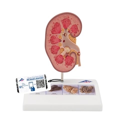 3B Scientific Kidney Stone Model - 3B Smart Anatomy