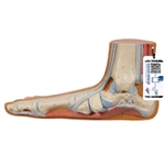3B Scientific Flat Foot (Pes Planus) Model - 3B Smart Anatomy