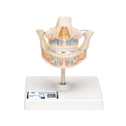 3B Scientific Milk Denture Model with Remaining Teeth - 3B Smart Anatomy