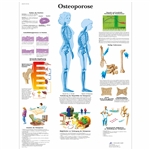 3B Scientific Osteoporosis Chart