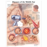 3B Scientific Diseases of the Middle Ear Chart (Laminated)