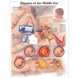 3B Scientific Diseases of the Middle Ear Chart (Laminated)