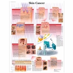 3B Scientific Skin Cancer Chart (Laminated)