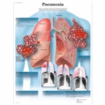 3B Scientific Pneumonia Chart (Laminated)