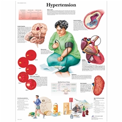 3B Scientific Hypertension Chart (Laminated)