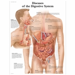 3B Scientific Diseases of the Digestive System Chart (Laminated)