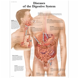 3B Scientific Diseases of the Digestive System Chart (Laminated)