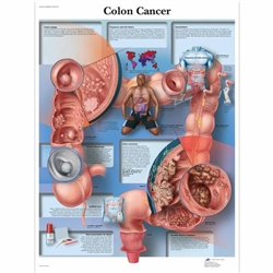 3B Scientific Colon Cancer Chart (Laminated)