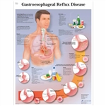 3B Scientific Gastroesophageal Reflux Disease Chart (Laminated)