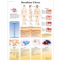 3B Scientific Decubitus Ulcers Chart (Lamination)