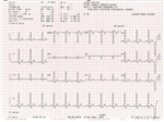 EKG Paper for Schiller Cardiovit MS-2015 - 1 Case of 10 Packs