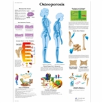 3B Scientific Osteoporosis Chart (Non - Laminated)