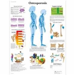 3B Scientific Osteoporosis Chart (Non - Laminated)