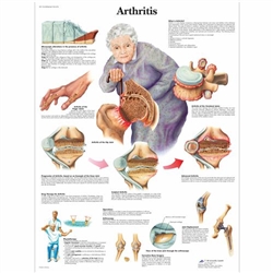 3B Scientific Arthritis Chart (Non - Laminated)