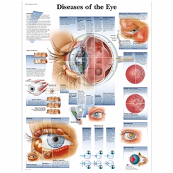 3B Scientific Diseases of the Eye Chart (Non Laminated)