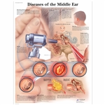3B Scientific Diseases of the Middle Ear Chart (Non Laminated)