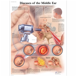 3B Scientific Diseases of the Middle Ear Chart (Non Laminated)