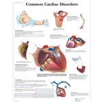 3B Scientific Common Cardiac Disorders Chart (Non Laminated)