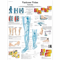 3B Scientific Varicose Veins Chart (Non Laminated)