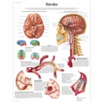 3B Scientific Stroke Chart (Non Laminated)