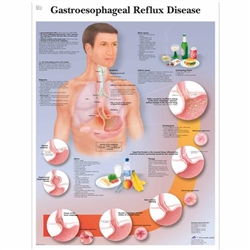 3B Scientific Gastroesophageal Reflux Disease Chart (Non Laminated)