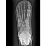 ERLER ZIMMER X-ray Phantom Foot (Opaque)