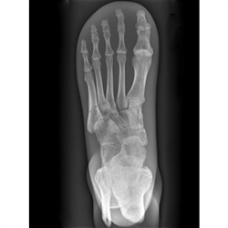 ERLER ZIMMER X-ray Phantom Foot (Opaque)