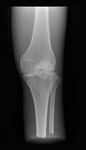 ERLER ZIMMER X-ray Phantom Knee (Opaque)