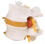 3B Scientific 2 Human Lumbar Vertebrae with Prolapsed Disc, Flexibly Mounted Smart Anatomy