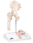 3B Scientific Human Femoral Fracture & Hip Osteoarthritis Model Smart Anatomy